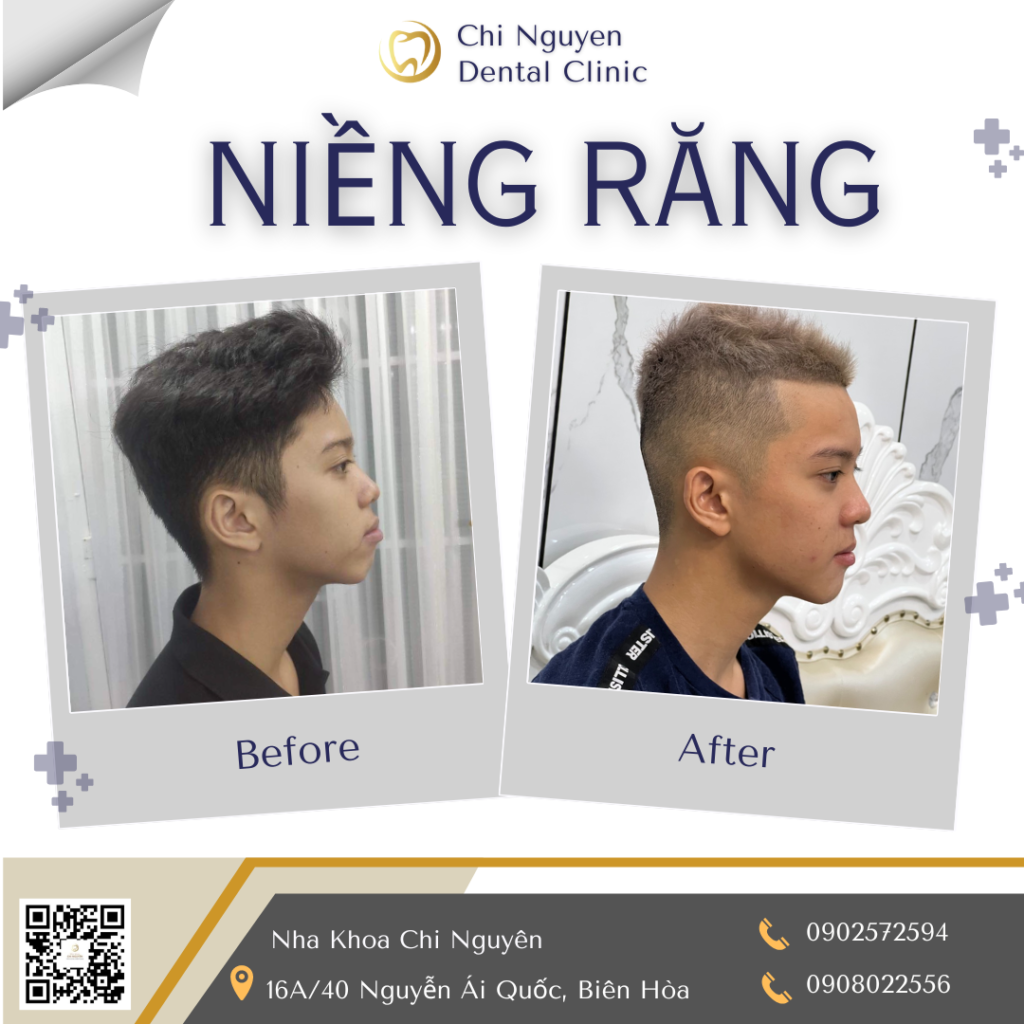 Hình ảnh khách hàng trước và sau khi niềng răng tại Nha Khoa Chi Nguyên.