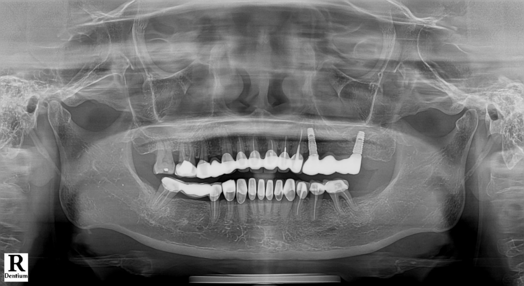 Sau khi cấy ghép Implant